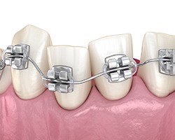 Illustration of metal braces on crooked teeth