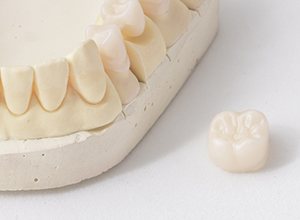 Model of smile and dental crown