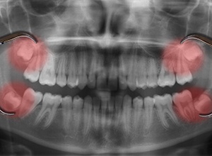 Panoramic smile x-ray showing developing wisdom teeth