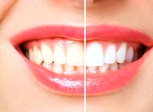 Side by side of teeth before and after whitening treatment