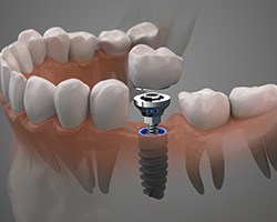 Illustration of dental implant between natural teeth