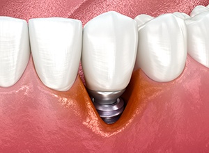 Illustration showing receding gums around dental implant